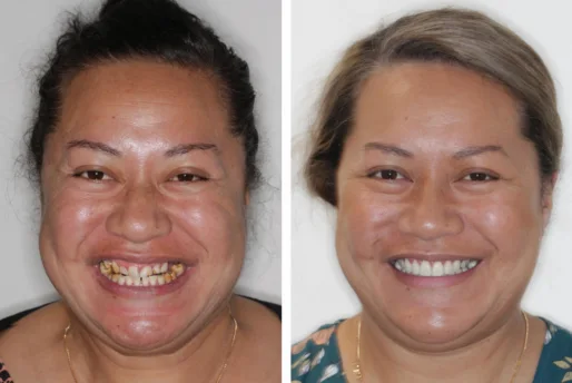 Case-3-Veneers-Before-and-After6