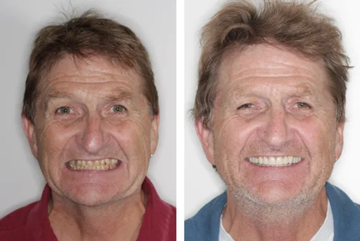 Case-4-Veneers-Before-and-Afte4