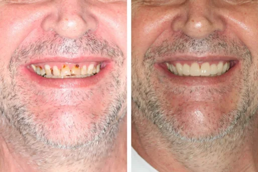 Case-5-Veneers-Before-and-After4552