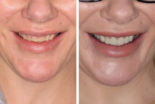 Case-6-Veneers-Before-and-After102